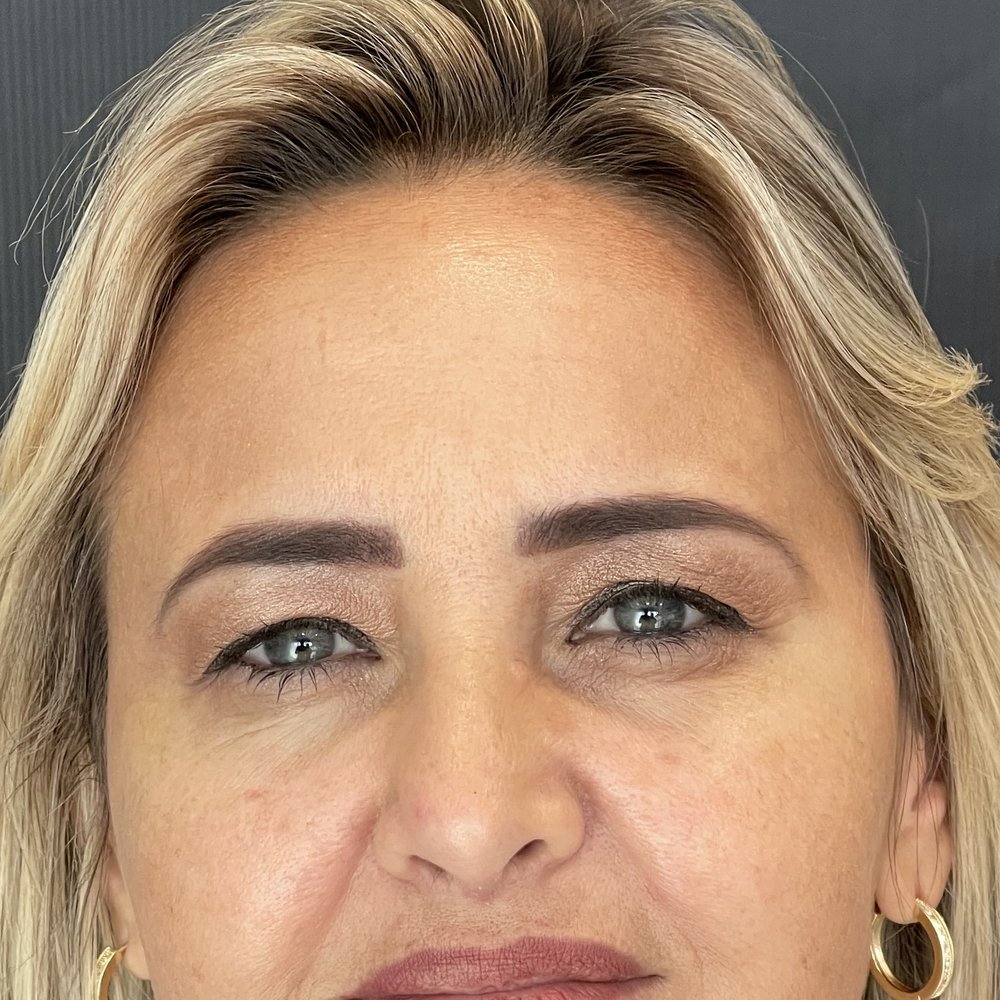 Antes do rejuvenescimento do olhar