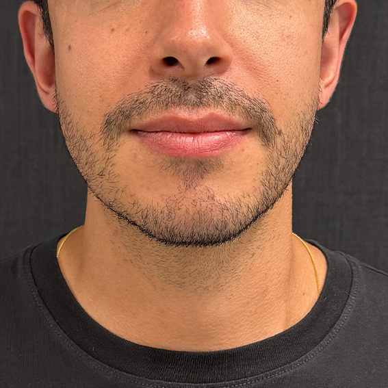Antes do full face masculino