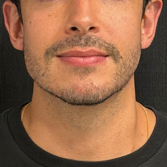 Depois do full face masculino