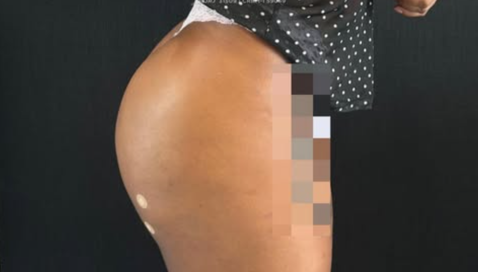 Depois da harmonização glútea