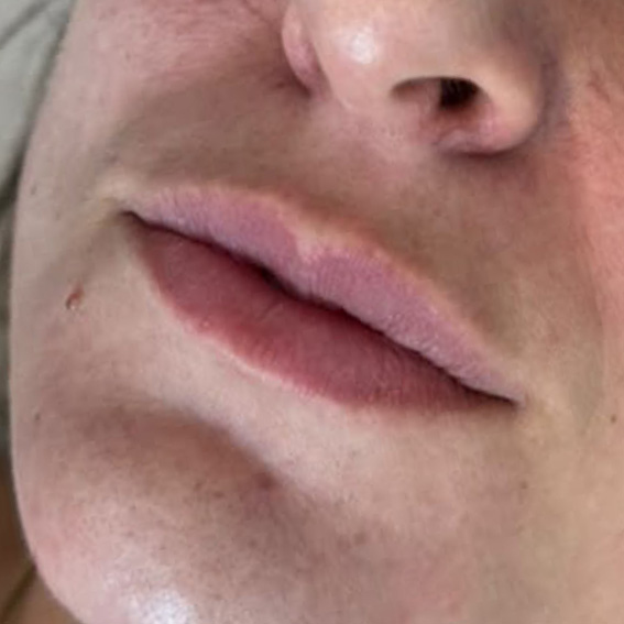 Antes do preenchimento labial