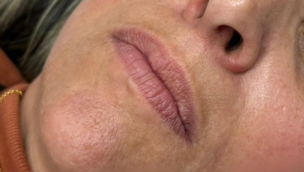 Antes do preenchimento labial