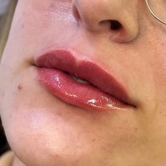 Depois do preenchimento labial