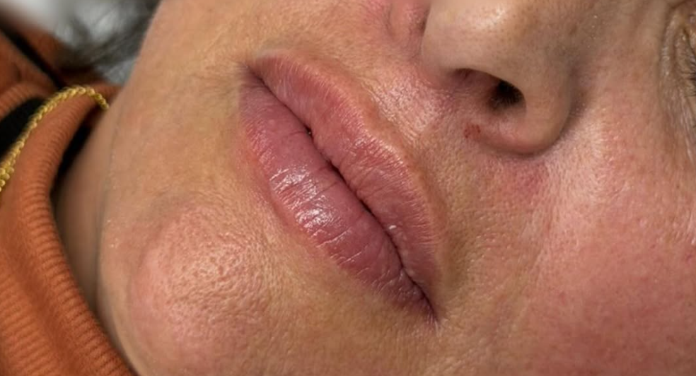 Depois do preenchimento labial